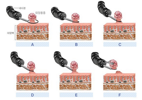 대장용종절제술 모식도