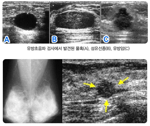 유방초음파검사에서 발견된 물혹, 섬유연종, 유방암